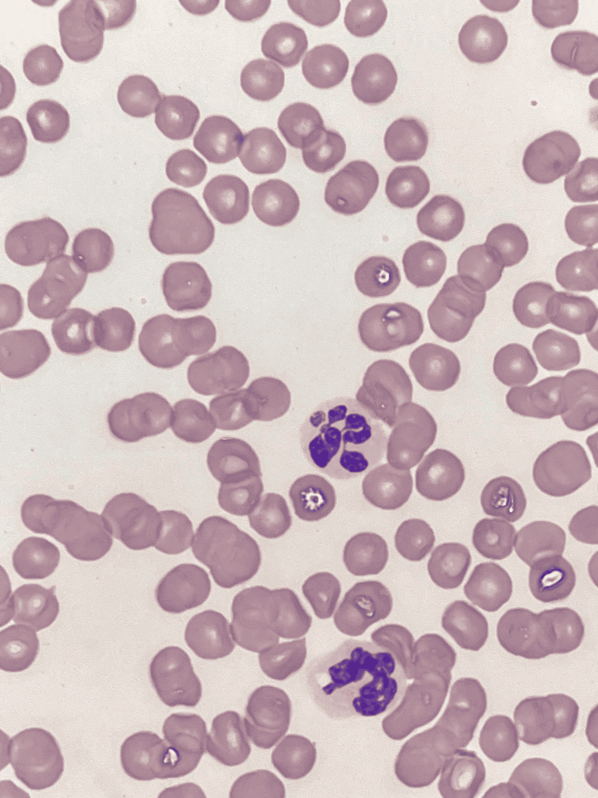 Microscopic image of cancer cells with purple stained nuclei, highlighting cellular abnormalities.