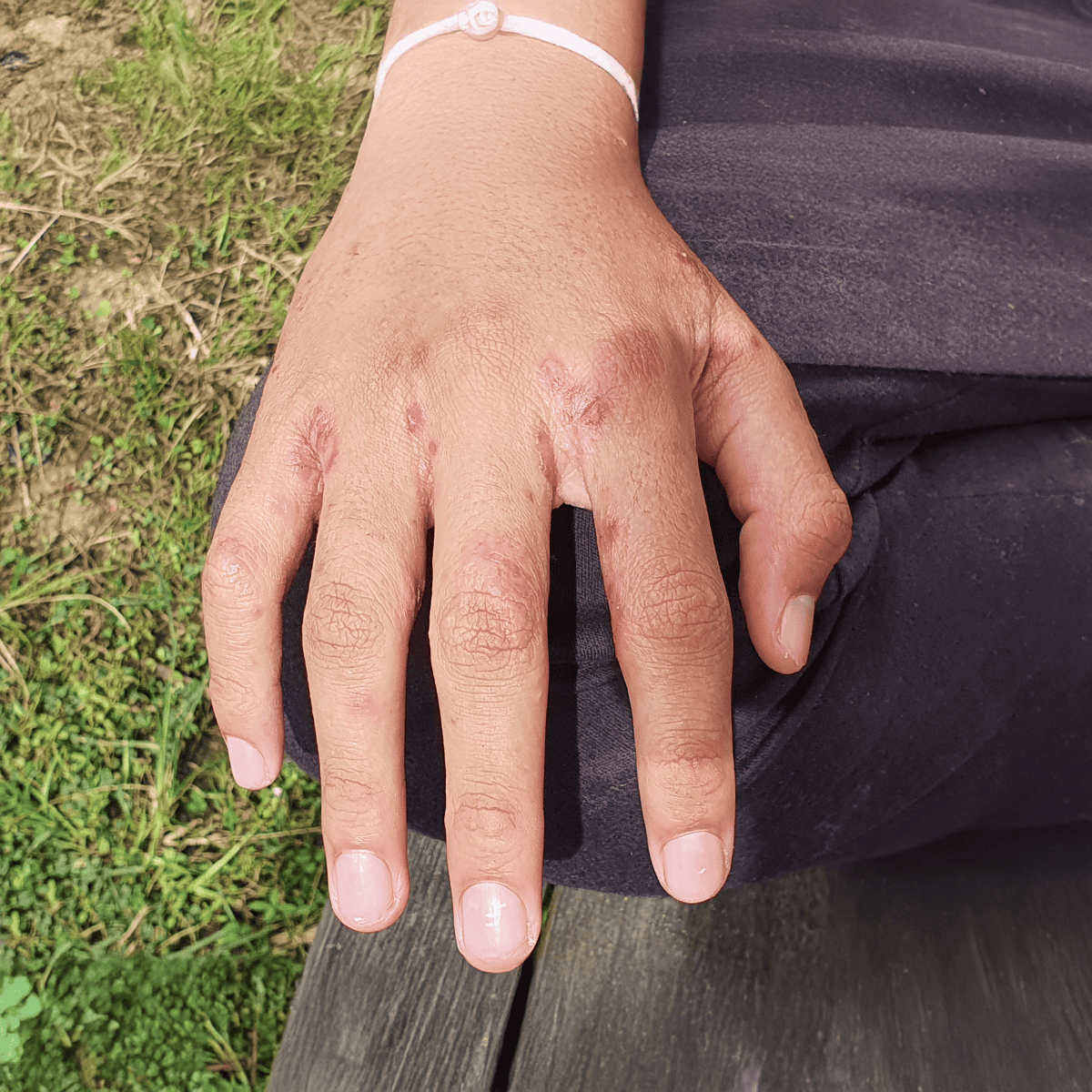 Close-up of a hand with visible scars and skin irritation, outdoors on a grassy background.